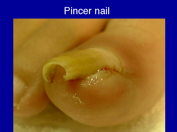 Slide 3 (pincer nail) 