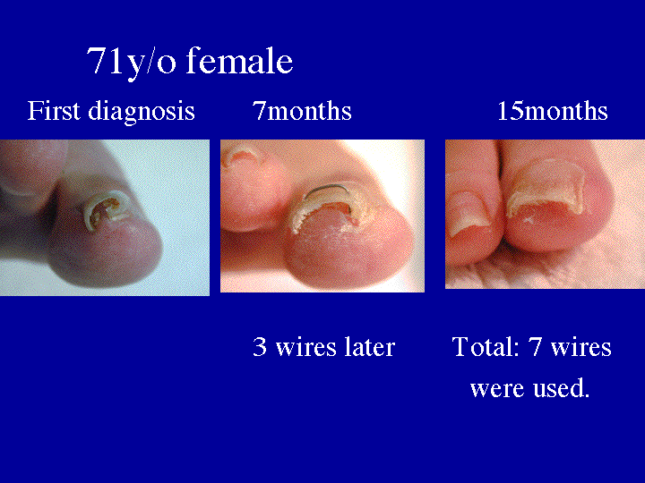 Slide  9 (71y/o patient) 