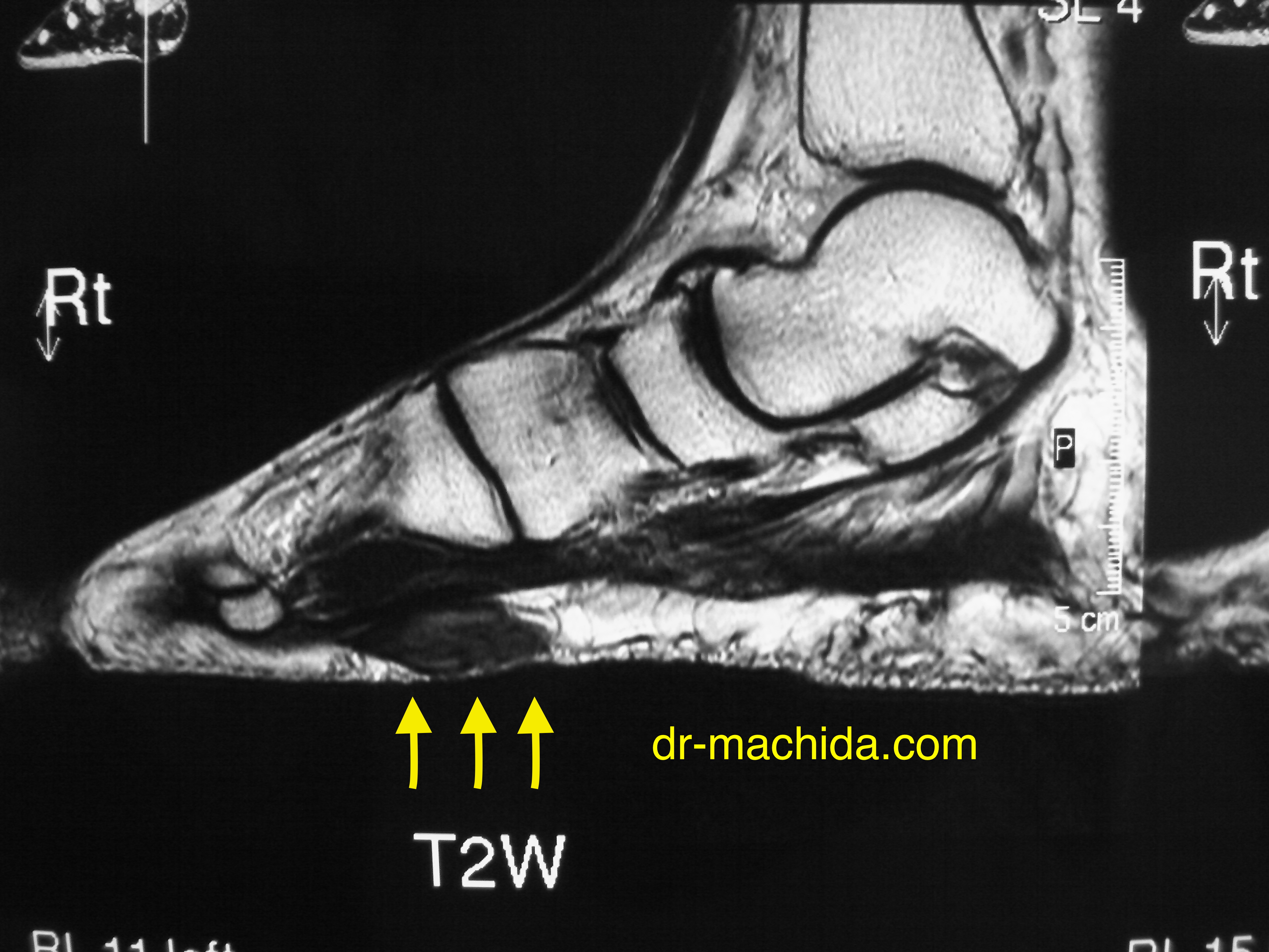 足底繊維種のMRI 画像
