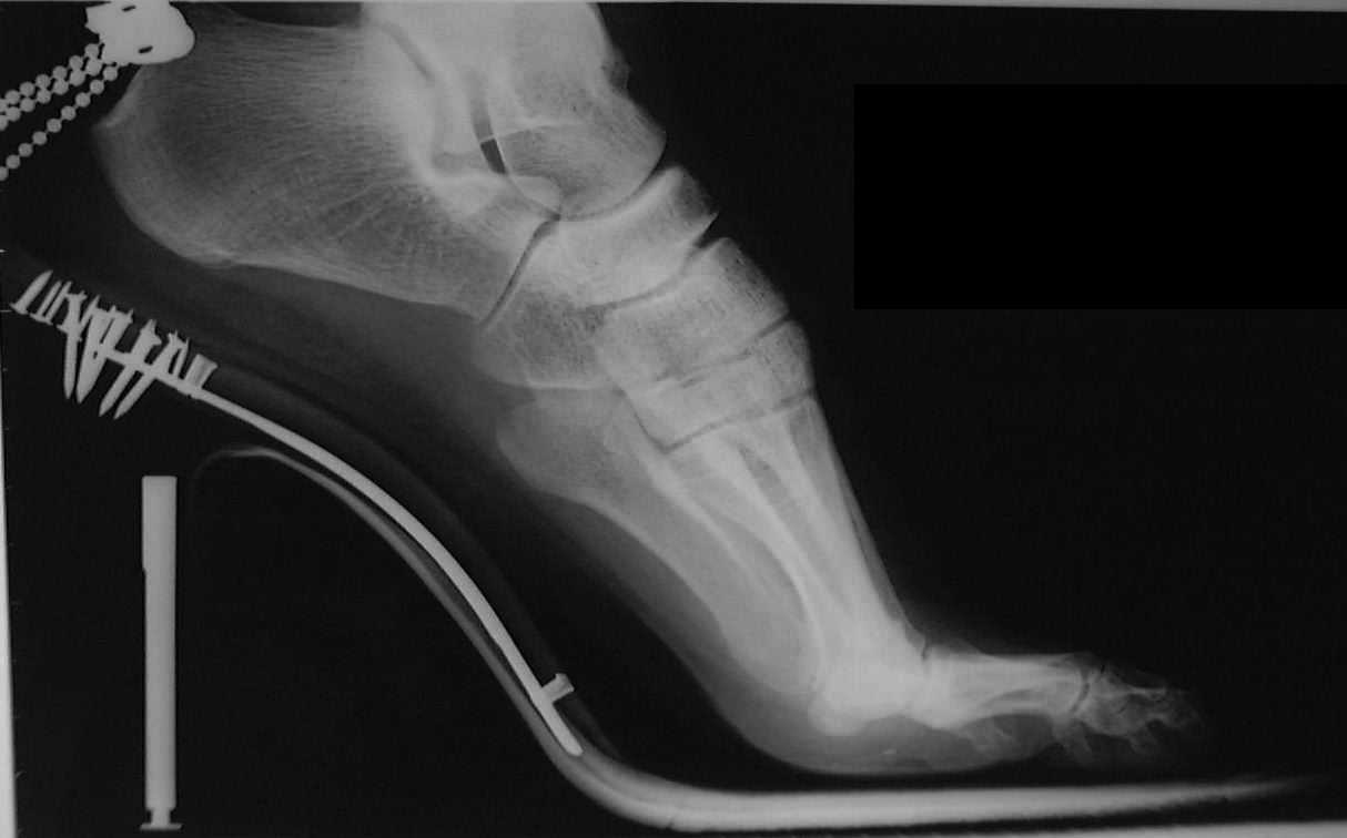 ハイヒールを履いた足のＸ線写真