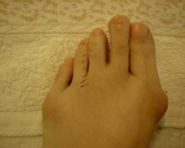 モートン神経腫の足の写真