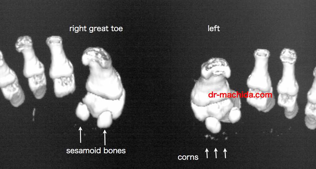 母趾種子骨の3D CT画像