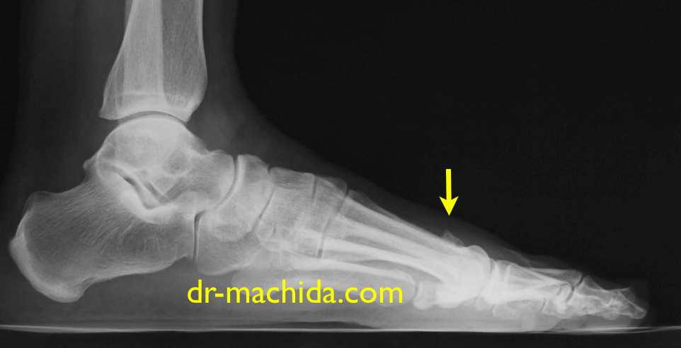 足背の骨棘　dorsal foot exostosis